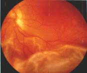 retinaldetach